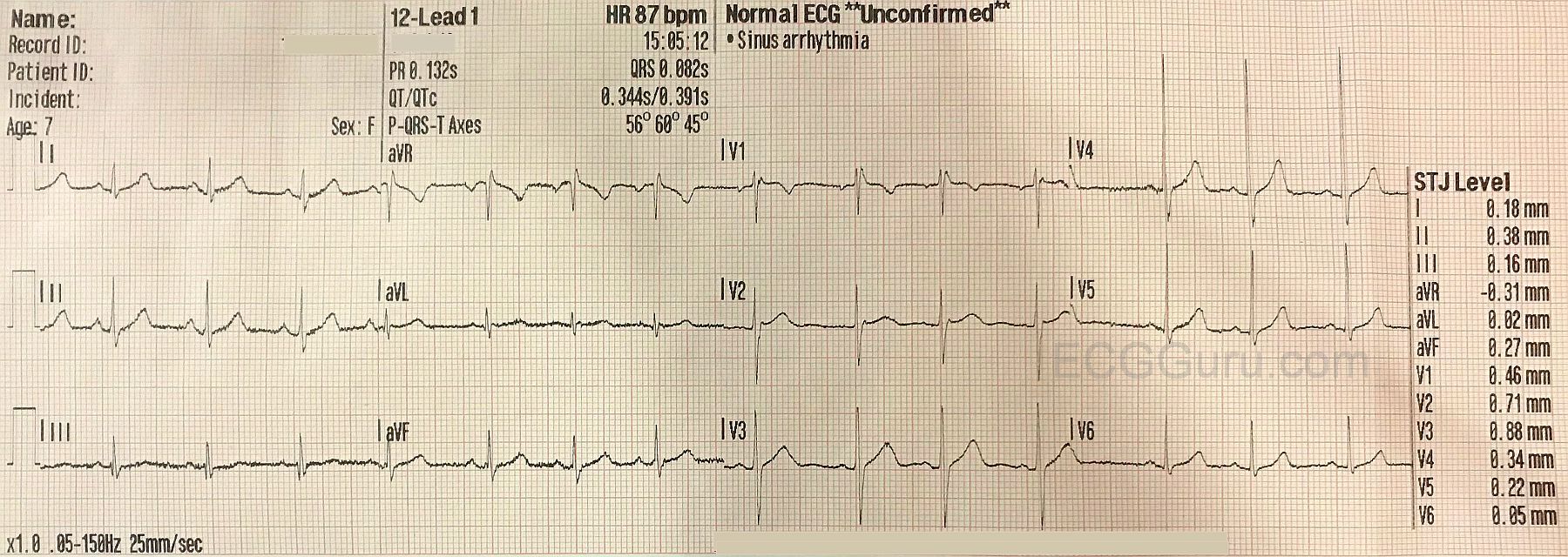 instructors-collection-ecg-normal-ecg-in-seven-year-old-girl-ecg